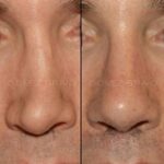 RINOPLASTIA SECUNDARIA 6