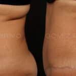 ABDOMINOPLASTIA 16