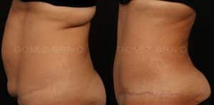 ABDOMINOPLASTIA 16