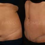 ABDOMINOPLASTIA 17