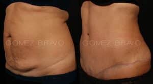 ABDOMINOPLASTIA 17