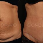 ABDOMINOPLASTIA 18