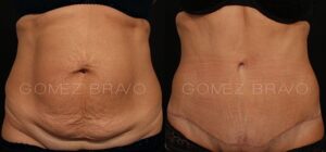 ABDOMINOPLASTIA 18