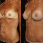 ABDOMINOPLASTIA 19