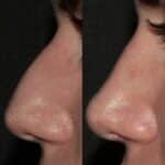 RINOPLASTIA 23