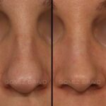RINOPLASTIA 2