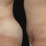 ABDOMINOPLASTIA 3