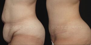 ABDOMINOPLASTIA 3