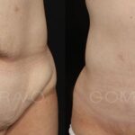 ABDOMINOPLASTIA 1