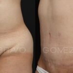 ABDOMINOPLASTIA 2