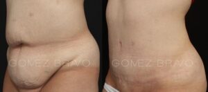 ABDOMINOPLASTIA 2