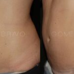 ABDOMINOPLASTIA 5