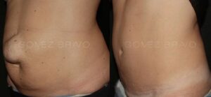 ABDOMINOPLASTIA 5