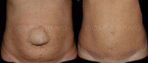 ABDOMINOPLASTIA 4