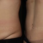 ABDOMINOPLASTIA 7