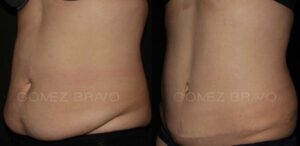 ABDOMINOPLASTIA 7