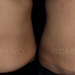 ABDOMINOPLASTIA 6