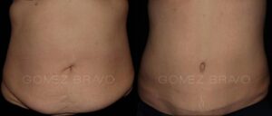 ABDOMINOPLASTIA 6