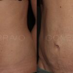 ABDOMINOPLASTIA 9