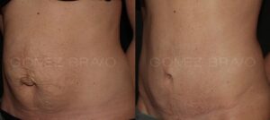 ABDOMINOPLASTIA 9