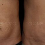 ABDOMINOPLASTIA 8