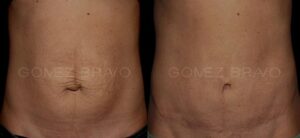 ABDOMINOPLASTIA 8