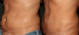 ABDOMINOPLASTIA 11