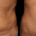 ABDOMINOPLASTIA 10