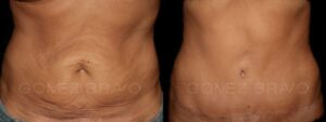 ABDOMINOPLASTIA 10