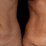 ABDOMINOPLASTIA 13