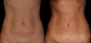 ABDOMINOPLASTIA 13