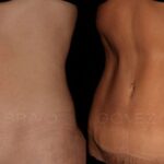 ABDOMINOPLASTIA 12