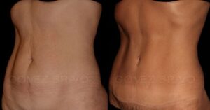 ABDOMINOPLASTIA 12