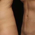 ABDOMINOPLASTIA 15