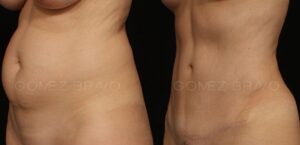 ABDOMINOPLASTIA 15