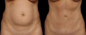 ABDOMINOPLASTIA 14