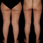 LIPOSUCCIÓN 9