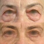 BLEFAROPLASTIA 8