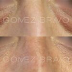 BLEFAROPLASTIA 5