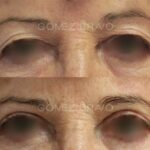 BLEFAROPLASTIA 6