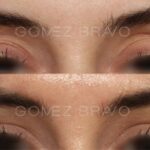 BLEFAROPLASTIA 7