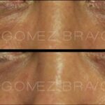 BLEFAROPLASTIA 18