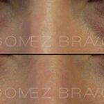 BLEFAROPLASTIA 15