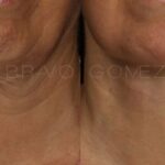 RECONSTRUCCIÓN FACIAL 2