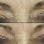 BLEFAROPLASTIA 13