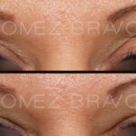 BLEFAROPLASTIA 11