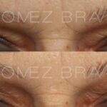 BLEFAROPLASTIA 12
