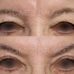 BLEFAROPLASTIA 10