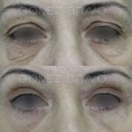 BLEFAROPLASTIA 9