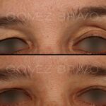 BLEFAROPLASTIA 3